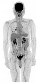 図PET9 みぎ肺がん、肺門リンパ節、 みぎ肺内転移。