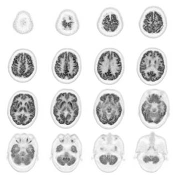 図PET11 健常成人の脳。分解能が高いだけでなく、灰白質と白質のコントラストにも優れる。