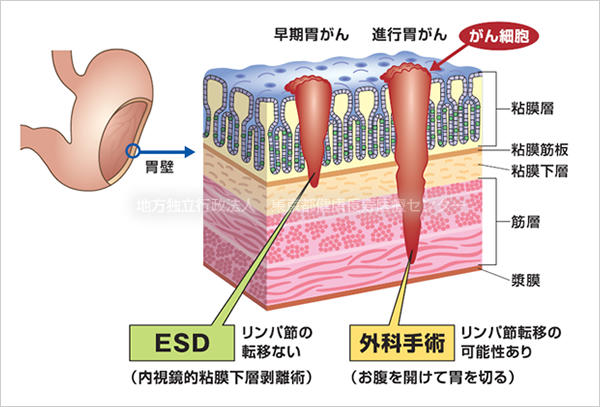 早期食道癌・早期胃癌・早期大腸癌