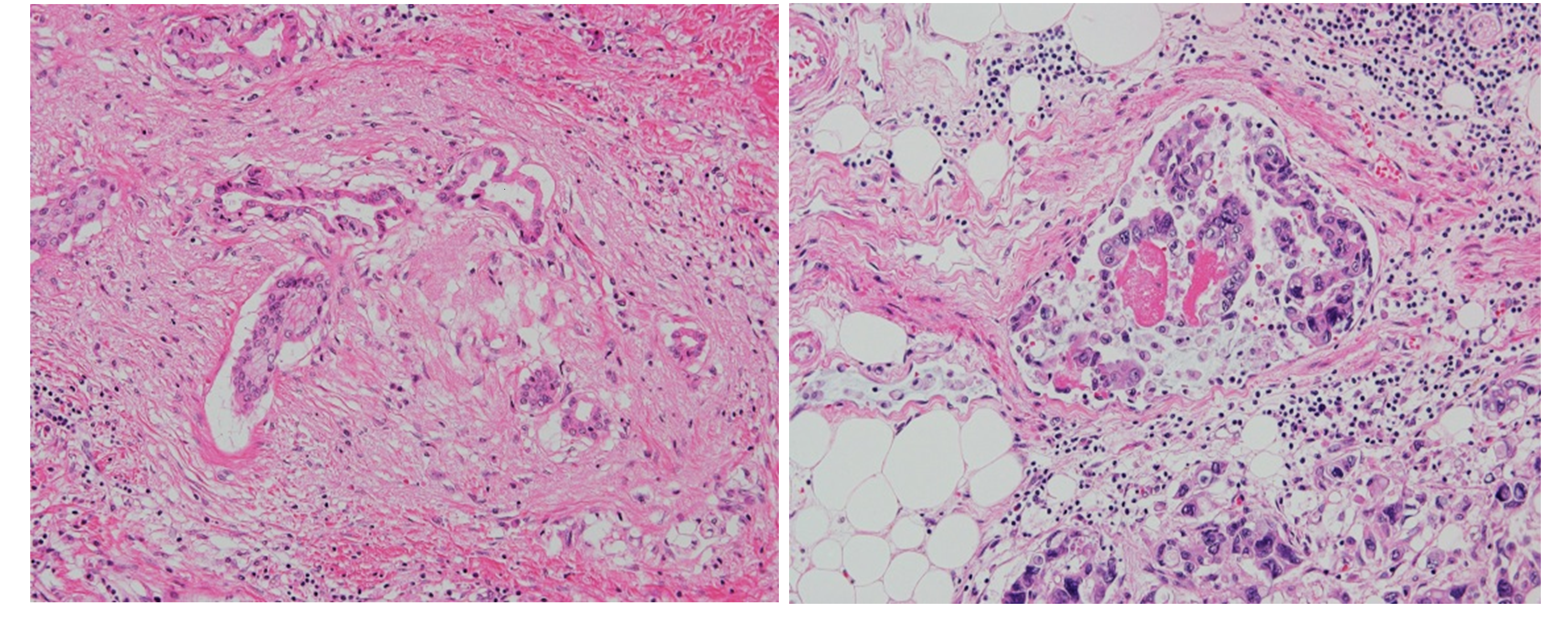 図1、不顕性癌の病理像、Hematoxylin & Eosin染色