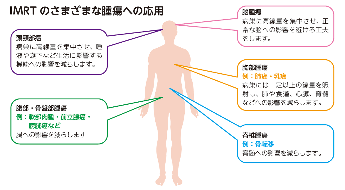 IMRTのさまざまな腫瘍への応用.png