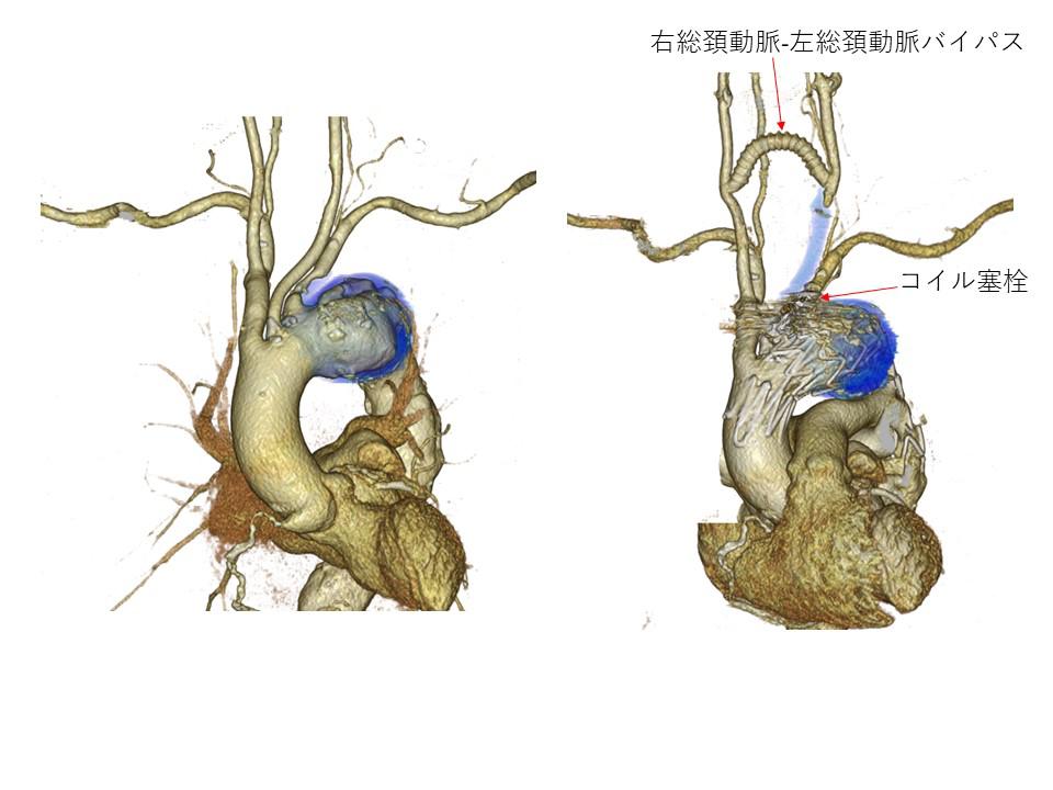 stent graft.jpg