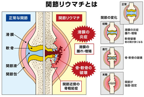 難病 関節 リウマチ FAQ 代表的な質問と回答例