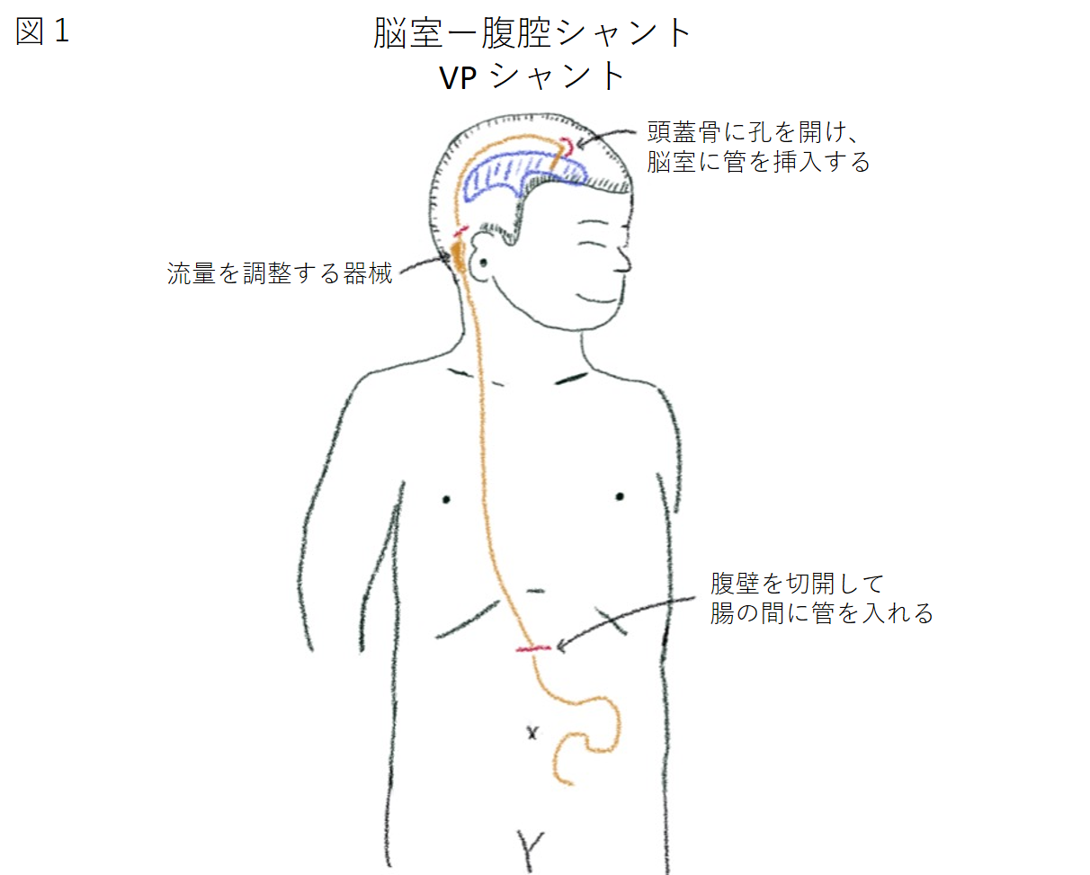 シャント は vp と