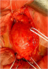 腹部大動脈瘤の開腹手術