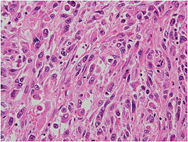 図4．退形成性癌 (紡錘形細胞型)．異型の強い紡錘形細胞を認める。