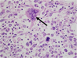 図2．退形成性癌．多核巨細胞の核は大小不同を示し (矢印)，cytokeratin 19 (+), CK AE1/AE3 (+), vimentin (+), CD68 (-)を示した。