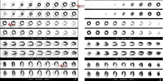 図2. D-SPECTと通常のSPECTの画質の違い ひだり: D-SPECT みぎ: 通常のSPECT . D-SPECTでは側壁の虚血がきれいに描出されている。（←矢印）