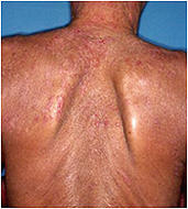 図２：ａ）アトピー性皮膚炎の 臨床像