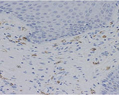ｂ）皮膚組織に浸潤するIgE抗体 陽性細胞（褐色に染色されている）