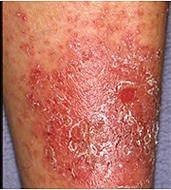 図１：接触皮膚炎　湿布薬貼付 部に湿疹皮膚炎が認められる。