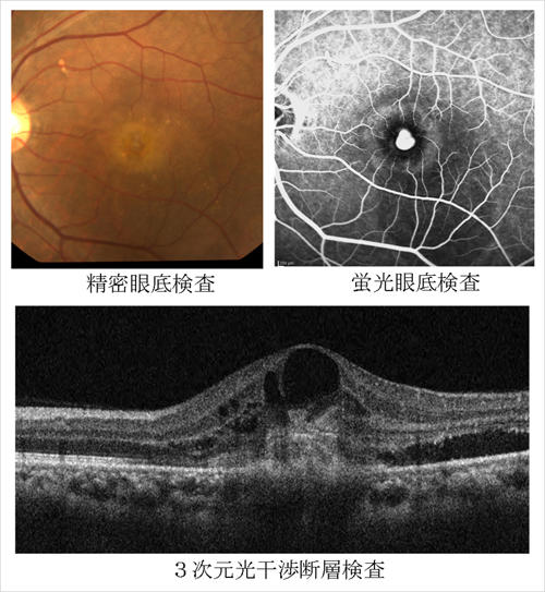加齢黄斑変性の診断