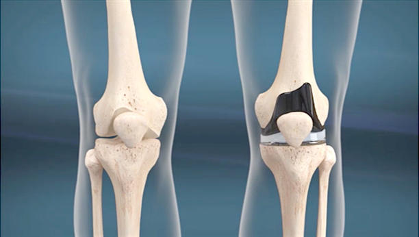 人工膝関節設置のイメージ画像