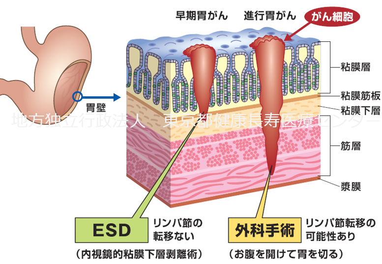 消化器内視鏡 14年7月号 26ー7 これが癌?癌じゃないの? 食道・胃編 [単行本] 消化器内視鏡編集委員会