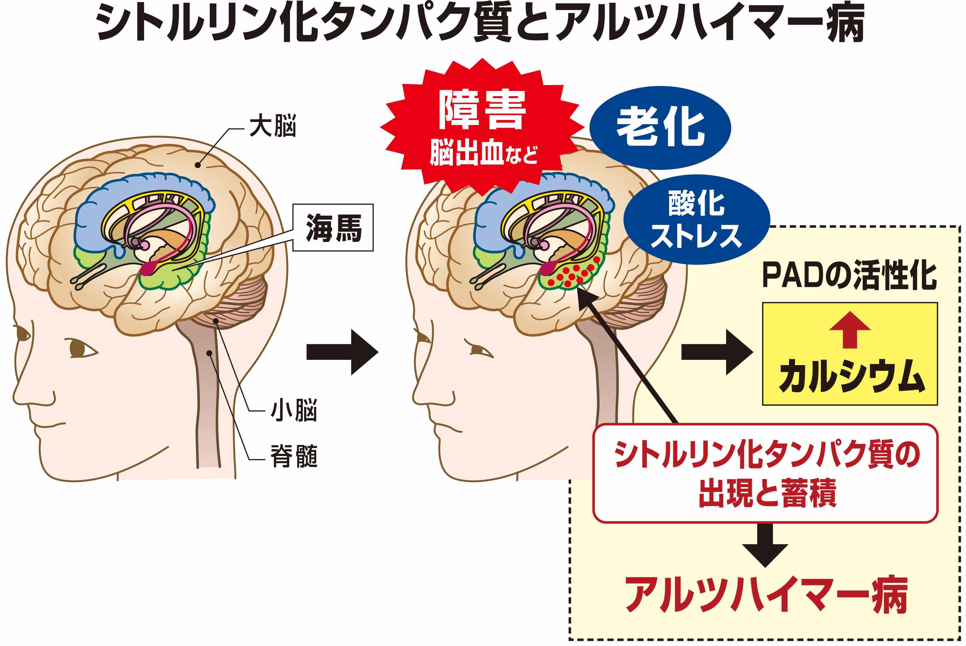 シトルリン化タンパク質とアルツハイマー病.jpg