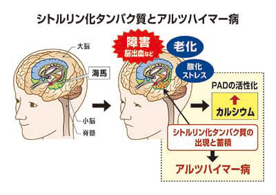シトルリン化タンパク質とアルツハイマー病