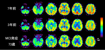 図1. 軽度認知障害（MCI）発症3−7年前の[18F]FDG-PET画像