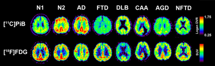 図2. 認知症関連疾患における[11C]PiBと[18F]FDG画像