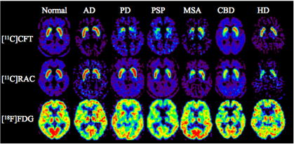図3. パーキンソン症候群における[11C]CFT、[11C]RACと[18F]FDG画像