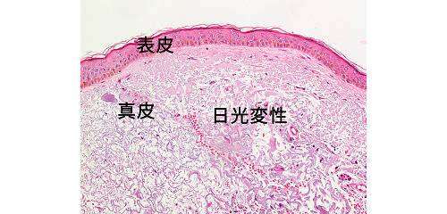 図３：日光に当たる皮膚（顔面）の顕微鏡写真