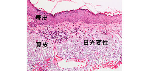 図４：日光角化症の近くの皮膚（顔面）の顕微鏡写真