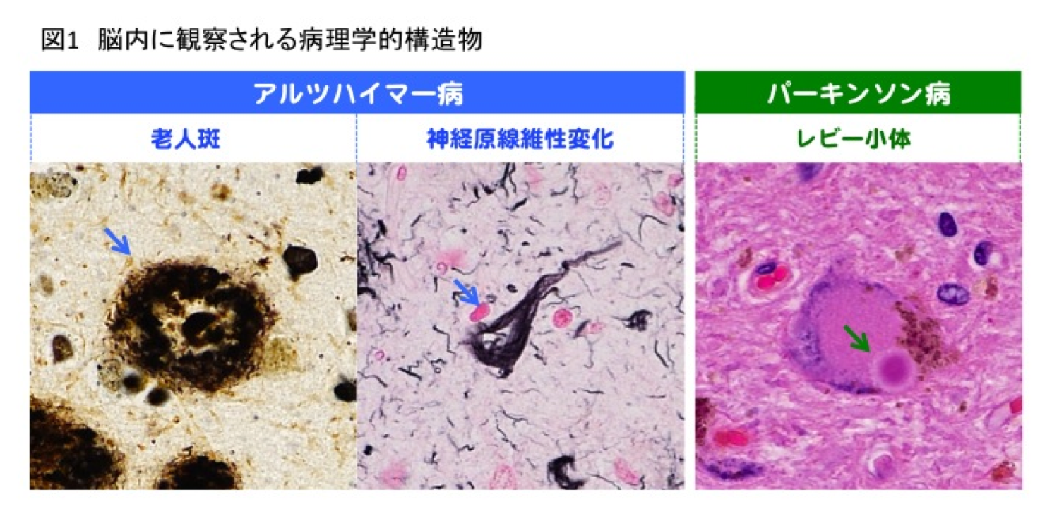 図1 脳内に観察される病理学的構造物